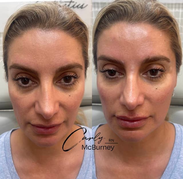 Carly McBurney filler and tox results