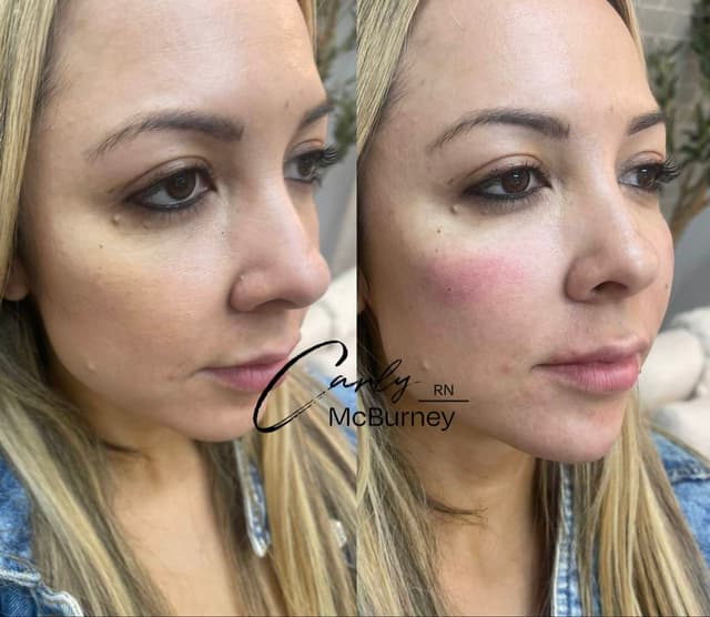 Carly McBurney full face rejuvenation filler