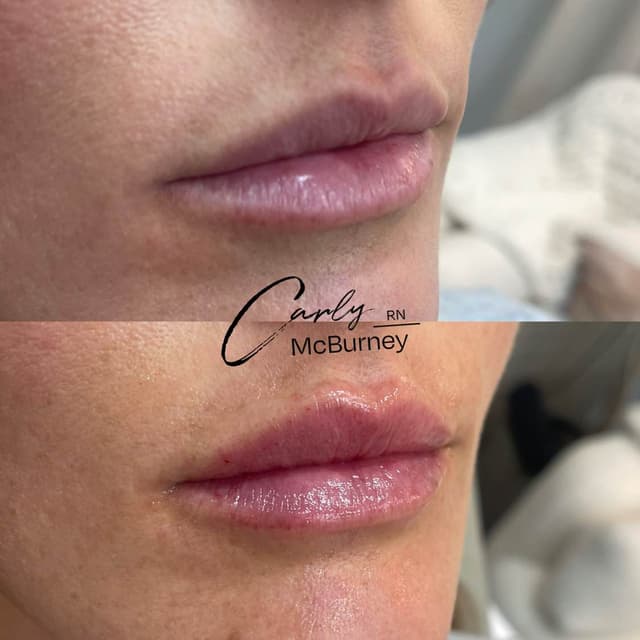 Carly McBurney Lip Before and after