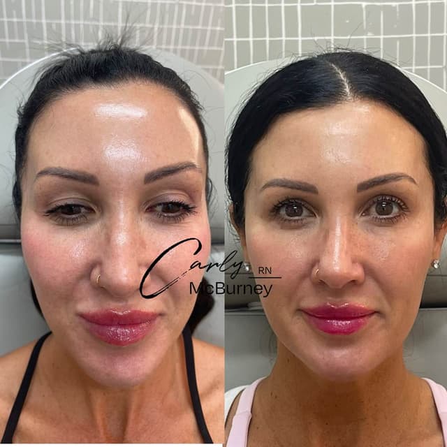 Filler results, natural youthful looking results