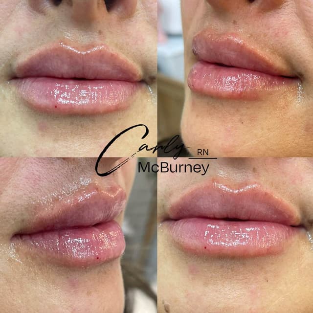 Carly McBurney Lip Before and after