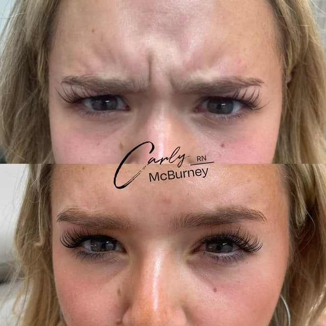 Carly McBurney Botox before and after results